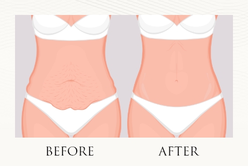 Tummy Tuck in Dubai